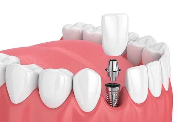 Mini vs. Regular Dental Implants from Brentwood Dental Group in Los Angeles, CA